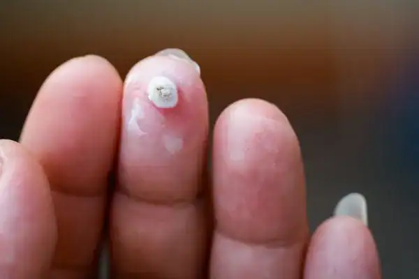 Image of white wart before cryopen treatment Stoke-upon-Trent