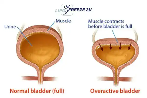 diagram of overactive bladder treatment Stoke-upon-Trent