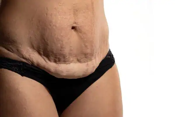 loose skin after weight loss injections Stoke-upon-Trent