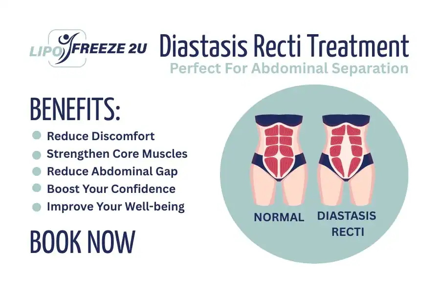 Benefits of body toning treatment Stoke-upon-Trent for Diastasis recti