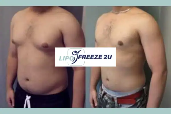 How Long Does It Take to See Results Stoke-upon-Trent?