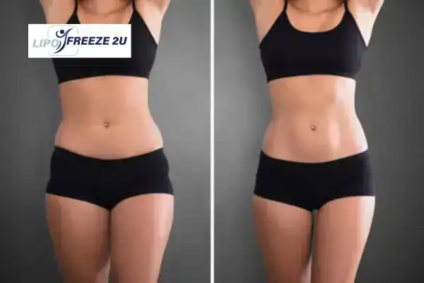 How Can LIPO FREEZE 2U Support Your Post-Pregnancy Body Recovery Stoke-upon-Trent?