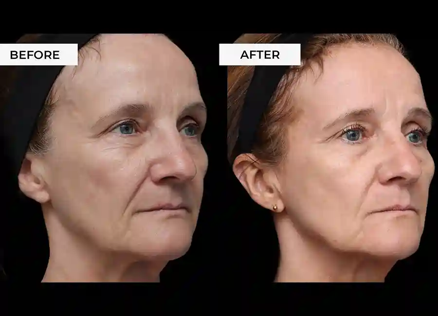 How Many RF Microneedling Sessions Will You Need to See a Difference Stoke-upon-Trent?