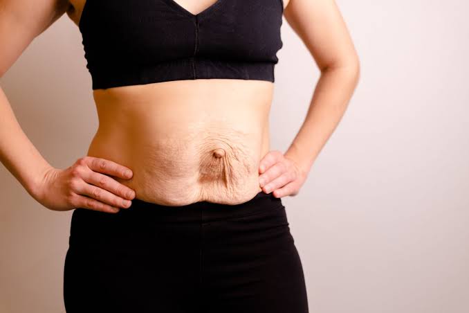Is Surgery Really the Only Way to Repair Diastasis Recti Stoke-upon-Trent?